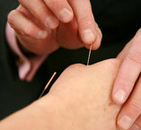 Acupuncture. LBaup1